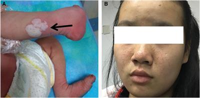 Cardiac self-limiting rhabdomyomas in a neonatal patient with tuberous sclerosis complex: a case report with negative genetic testing